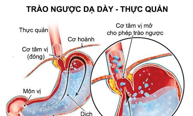 Thăm dò chức năng thực quản, dạ dày