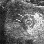 Triệu chứng và chẩn đoán viêm ruột thừa và thai nghén