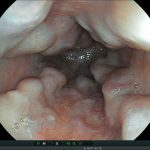 Kỹ thuật nội soi điều trị giãn tĩnh mạch thực quản