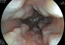 Kỹ thuật nội soi điều trị giãn tĩnh mạch thực quản