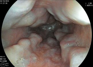 Kỹ thuật nội soi điều trị giãn tĩnh mạch thực quản