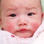 Một số điều cần biết về thiếu máu tan máu nguyên nhân ngoài hồng cầu