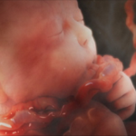 Một số điều cần biết về đẻ khó do dây rốn ngắn