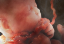 Một số điều cần biết về đẻ khó do dây rốn ngắn