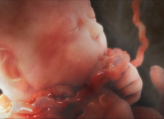 Một số điều cần biết về đẻ khó do dây rốn ngắn