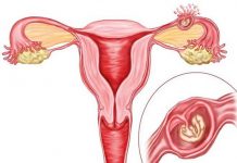 Nguyên nhân và xử trí một số trường hợp thai ngoài tử cung