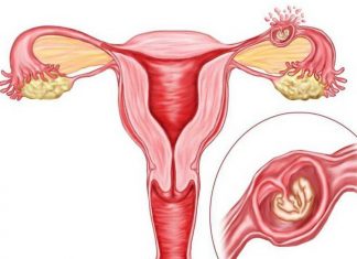 Nguyên nhân và xử trí một số trường hợp thai ngoài tử cung