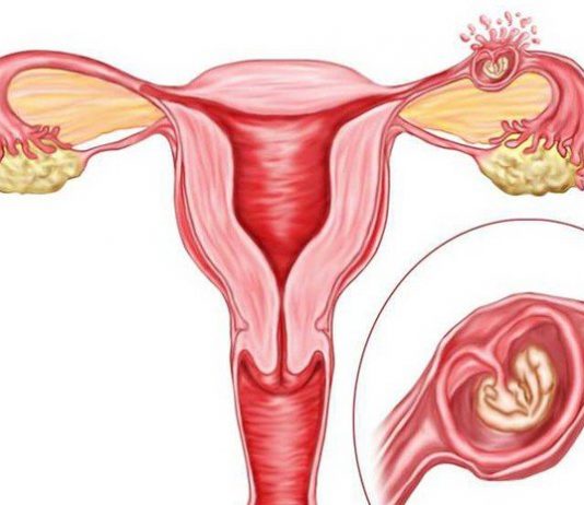 Nguyên nhân và xử trí một số trường hợp thai ngoài tử cung