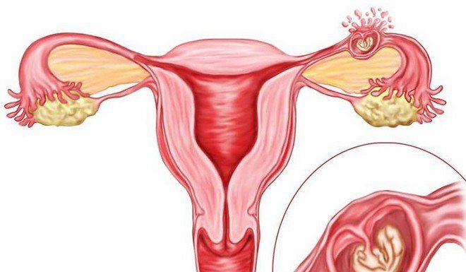 Nguyên nhân và xử trí một số trường hợp thai ngoài tử cung