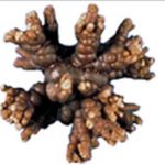 Các chẩn đoán lâm sàng và chẩn đoán phân biệt sỏi tiết niệu