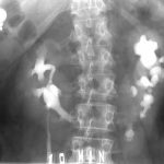 Xét nghiệm và chẩn đoán hình ảnh chẩn đoán sỏi tiết niệu