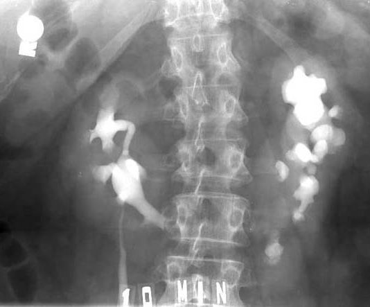 Xét nghiệm và chẩn đoán hình ảnh chẩn đoán sỏi tiết niệu