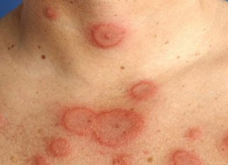 Những việc cần làm khi nghi ngờ phản ứng bất lợi của thuốc