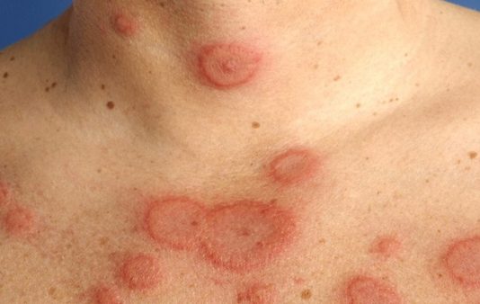 TRIỆU CHỨNG BÁO HIỆU UNG THƯ