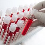 Nguyên nhân và chẩn đoán bệnh Leu-xơ-mi kinh dòng bạch cầu hạt