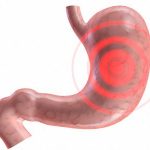 Viêm dạ dày: Phân loại và sinh lý bệnh