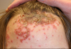 Biểu hiện và phòng bệnh chốc (Impetigo)