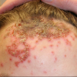Biểu hiện và phòng bệnh chốc (Impetigo)