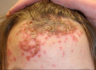 Biểu hiện và phòng bệnh chốc (Impetigo)