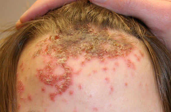 Biểu hiện và phòng bệnh chốc (Impetigo)