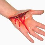 Một số điều cần biết về nguyên nhân gây suy thận cấp