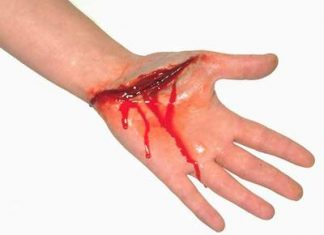 Một số điều cần biết về nguyên nhân gây suy thận cấp
