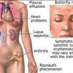 Chẩn đoán và điều trị Lupus ban đỏ hệ thống