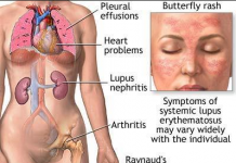 Chẩn đoán và điều trị Lupus ban đỏ hệ thống