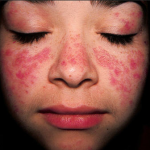 Bệnh Lupus ban đỏ dạng đĩa