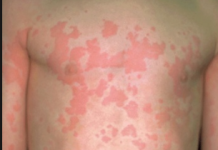 Biểu hiện và điều trị bệnh mày đay