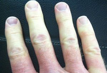 Biểu hiện Hội chứng Raynaud