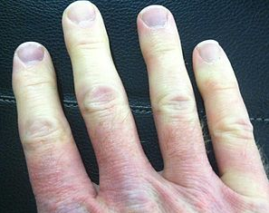 Điều trị hội chứng Raynaud