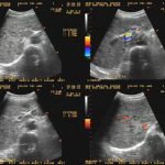 Thăm dò hình thái đường tiêu hóa bằng siêu âm qua thành bụng