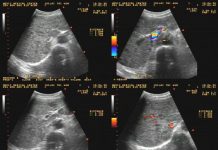 Thăm dò hình thái đường tiêu hóa bằng siêu âm qua thành bụng