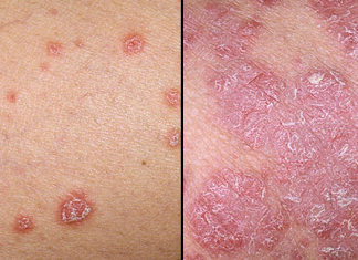 Phân biệt và tiến triển bệnh vảy nến