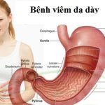 Sinh lý bệnh hệ tiêu hóa.