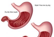 Đại thể và vi thể của bệnh viêm dạ dày mãn tính.