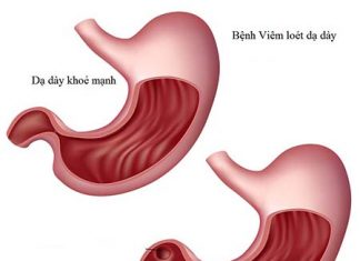 Đại thể và vi thể của bệnh viêm dạ dày mãn tính.