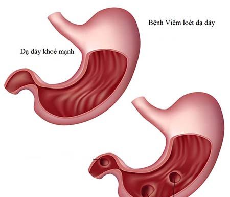 Phân loại mô bệnh học viêm dạ dày mạn.