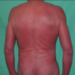 Điều trị bệnh đỏ da toàn thân