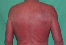 Các thể bệnh đỏ da toàn thân