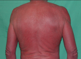 Điều trị bệnh đỏ da toàn thân