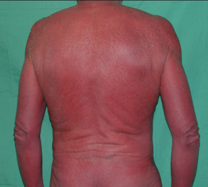 Các thể bệnh đỏ da toàn thân