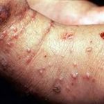 Điều trị và phòng bệnh ghẻ bệnh ghẻ