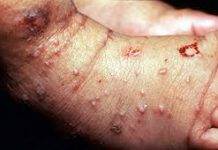 Biểu hiện bệnh ghẻ bệnh ghẻ