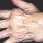 Các thể của bệnh phong bệnh phong