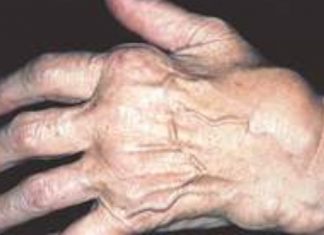 Các thể của bệnh phong bệnh phong