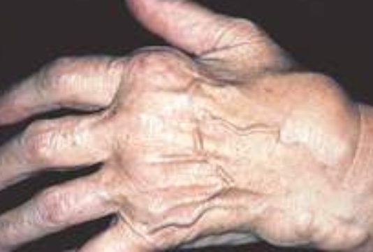 Các thể của bệnh phong bệnh phong