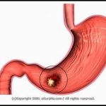 Các yếu tố nguyên nhân gây ung thư dạ dày