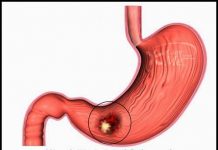 Các yếu tố nguyên nhân gây ung thư dạ dày